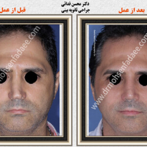 جراحی بینی