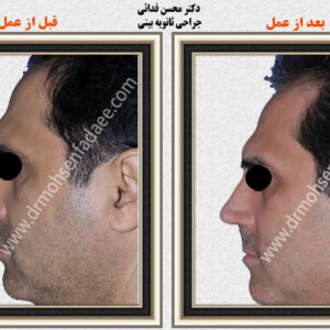 جراحی بینی