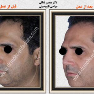 جراحی بینی