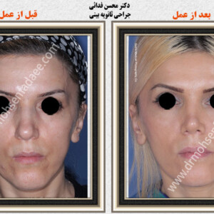 جراحی بینی