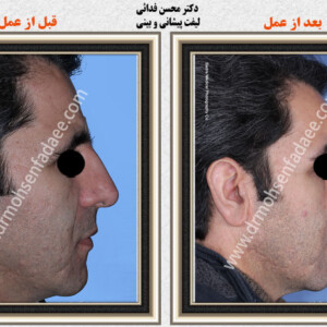 لیفت صورت