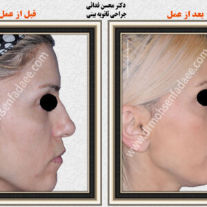 جراحی بینی