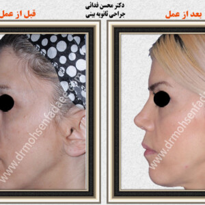 جراحی بینی