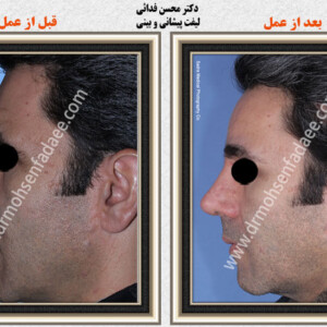 لیفت صورت