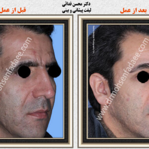 لیفت صورت