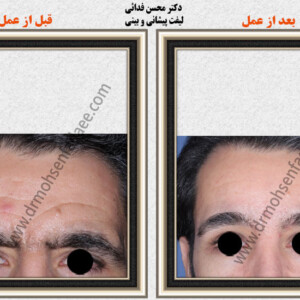 لیفت صورت