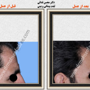 لیفت صورت