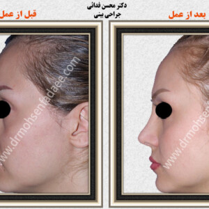 جراحی بینی