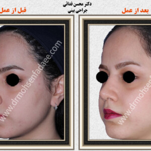 جراحی بینی