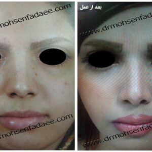 جراحی بینی