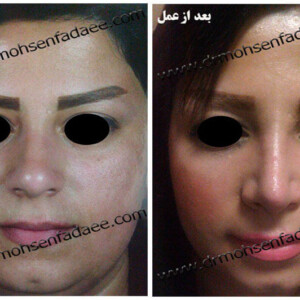 جراحی بینی