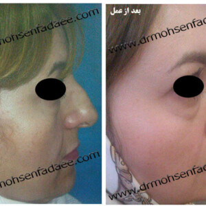 جراحی بینی