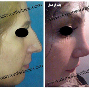 جراحی بینی