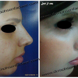 جراحی بینی