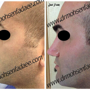 جراحی بینی