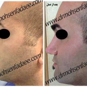 جراحی بینی (رینوپلاستی)