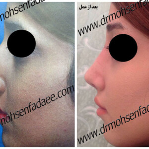 جراحی بینی
