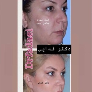 لیفت