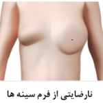 ترمیم سینه