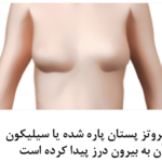 جراحی ترمیم مجدد سینه