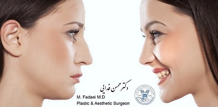 Open Rhinoplasty