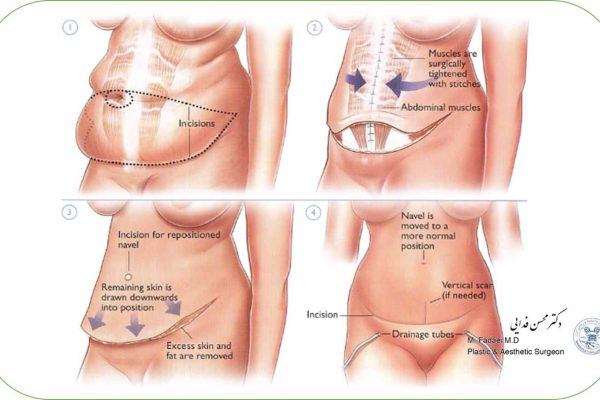 abdominoplasty