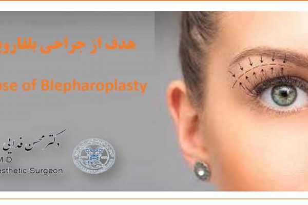 بلفاروپلاستی blepharoplasty