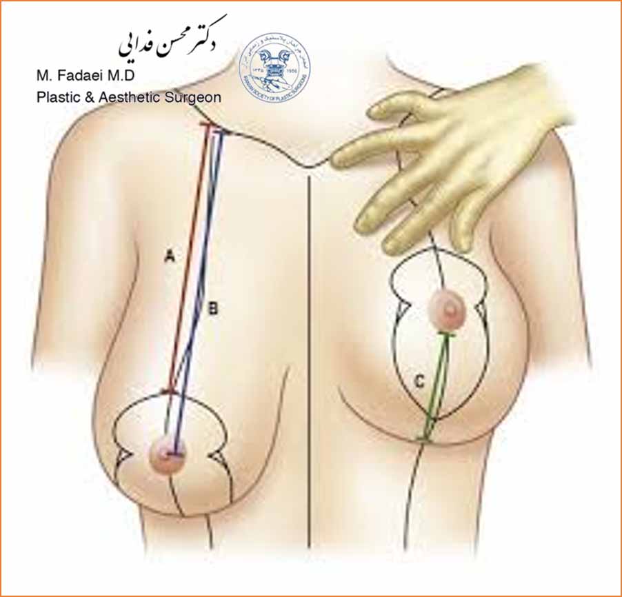 جراحی لیفت سینه