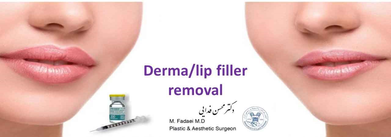 filler removal