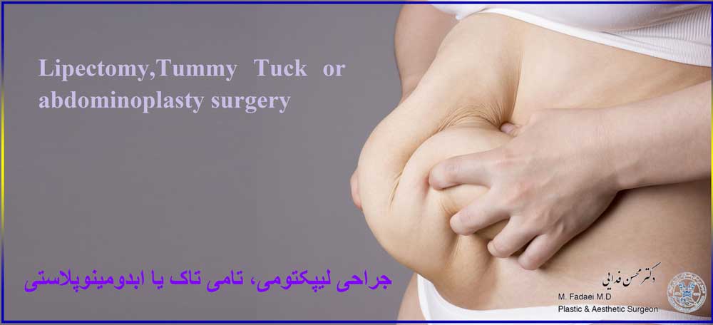 لیپکتومی ، تامی تاک ، ابدومینوپلاستی - Lipectomy , Tummy Tuck or abdominoplasty