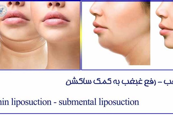 ساکشن غبغب - Double Chin suction