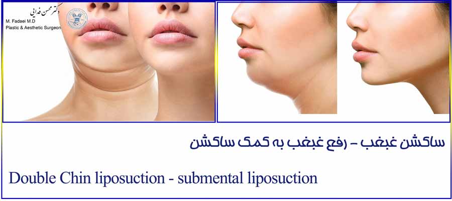 ساکشن غبغب - Double Chin suction