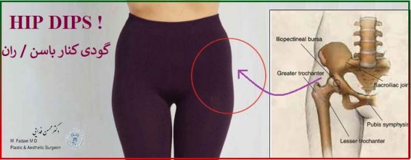 رفع گودی کنار باسن با تزریق چربی - Fat Transfer to Hip Dips - إصلاح الغمازة بجانب الأرداف