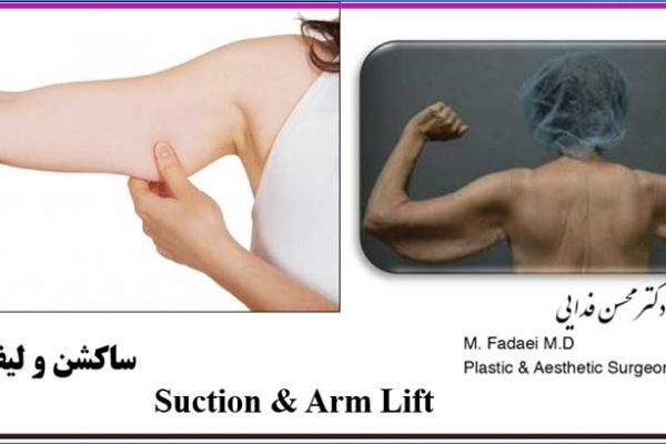 ساکشن و لیفت بازو - Suction and arm lift surgery