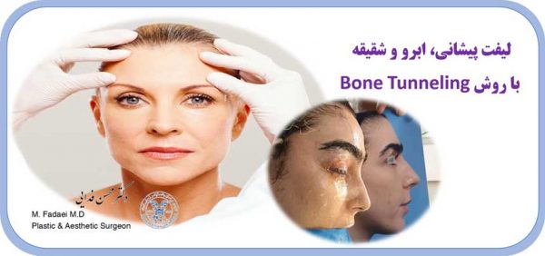 لیفت پیشانی و ابرو به روش bone tunneling