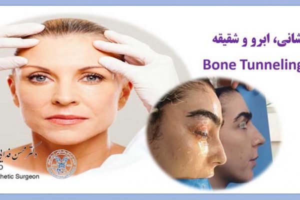 لیفت پیشانی و ابرو به روش bone tunneling