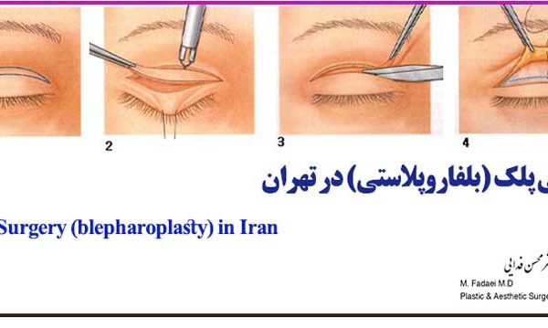 جراحی پلک (بلفاروپلاستی) - Eyelid Surgery (Blepharoplasty)