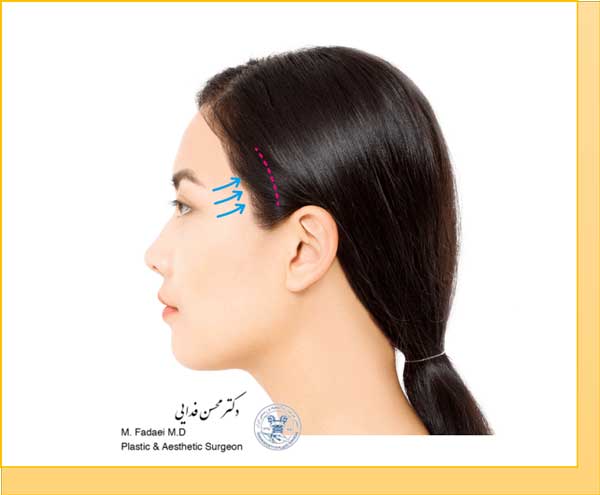 لیفت شقیقه و ابرو - Temple & Brow Lift