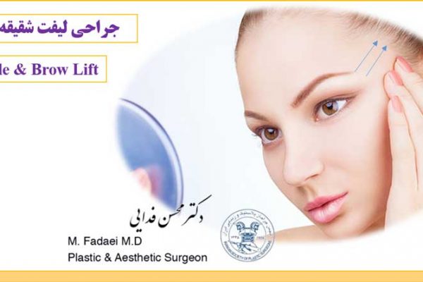 لیفت شقیقه و ابرو - Temple & Brow Lift - سحب العین