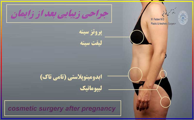 جراحی زیبایی بعد از زایمان - cosmetic surgery after pregnancy - جراحة التجمیل بعد الولادة