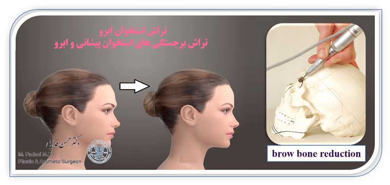 تراش استخوان ابرو - brow bone shaving