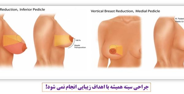 کاهش سایز سینه - جراحی سینه همیشه با اهداف زیبایی انجام نمی شود!