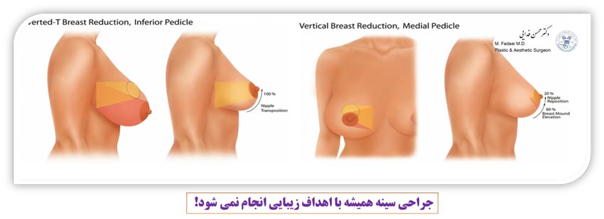 کاهش سایز سینه - جراحی سینه همیشه با اهداف زیبایی انجام نمی شود!