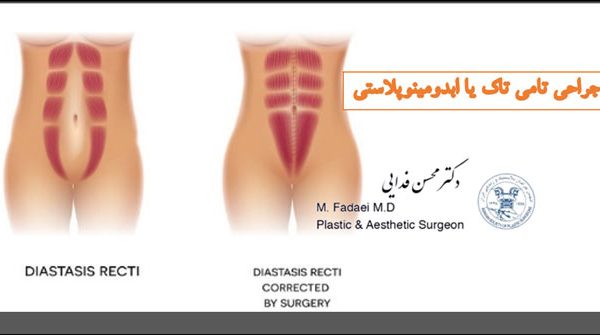 جراحی تامی تاک یا ابدومینوپلاستی