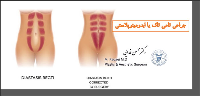 جراحی تامی تاک یا ابدومینوپلاستی