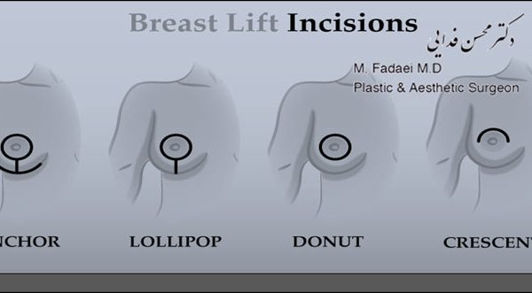 تکنیک های برش در جراحی لیفت سینه