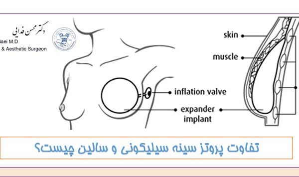 تفاوت پروتز سینه سیلیکونی و سالین چیست؟