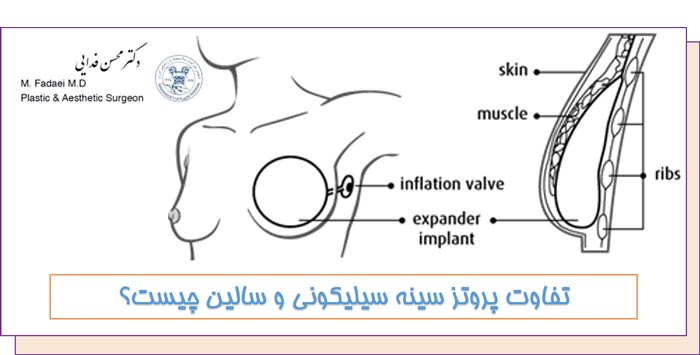 تفاوت پروتز سینه سیلیکونی و سالین چیست؟