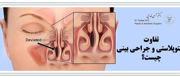 سپتوپلاستی و جراحی بینی