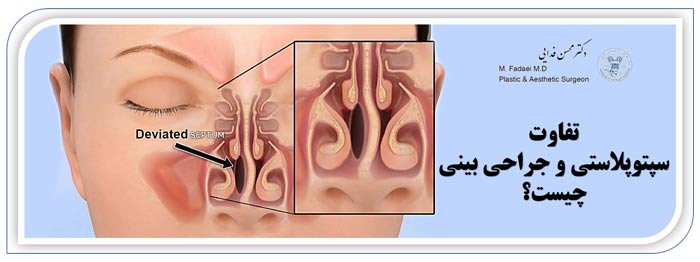 سپتوپلاستی و جراحی بینی